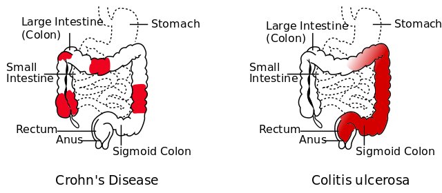 Que sont les maladies Inflammatoires Chroniques de l’Intestin ?