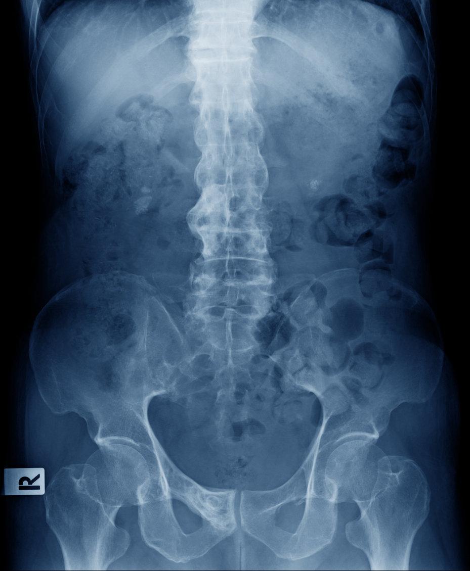Quelles sont les complications de la spondylarthrite ankylosante ?
