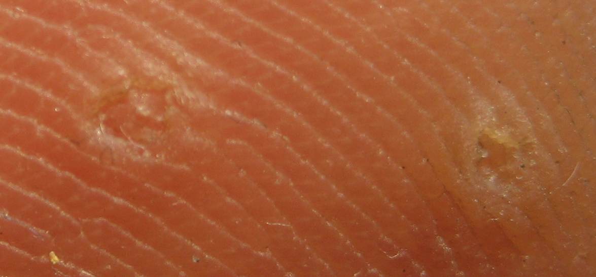 Qu'est-ce qu'une verrue plantaire ?