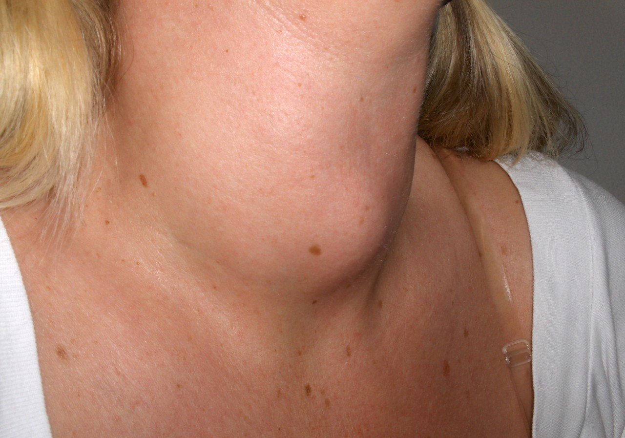 Le goitre : un symptôme des dysfonctionnements thyroïdiens