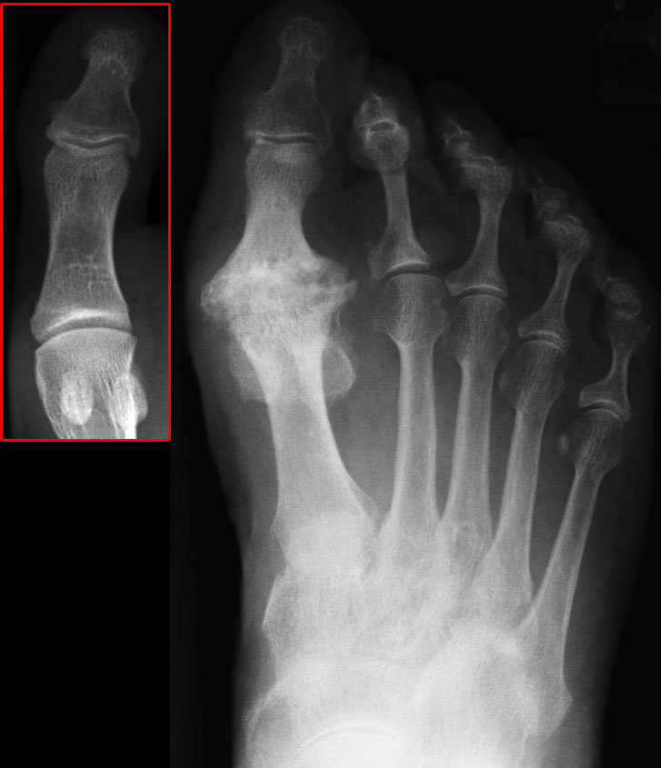 Qu'est-ce que l’hallux rigidus ?