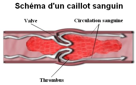 Définition : qu'est-ce qu'une embolie pulmonaire ?
