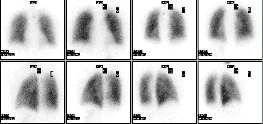 La scintigraphie pulmonaire ventilation-perfusion 