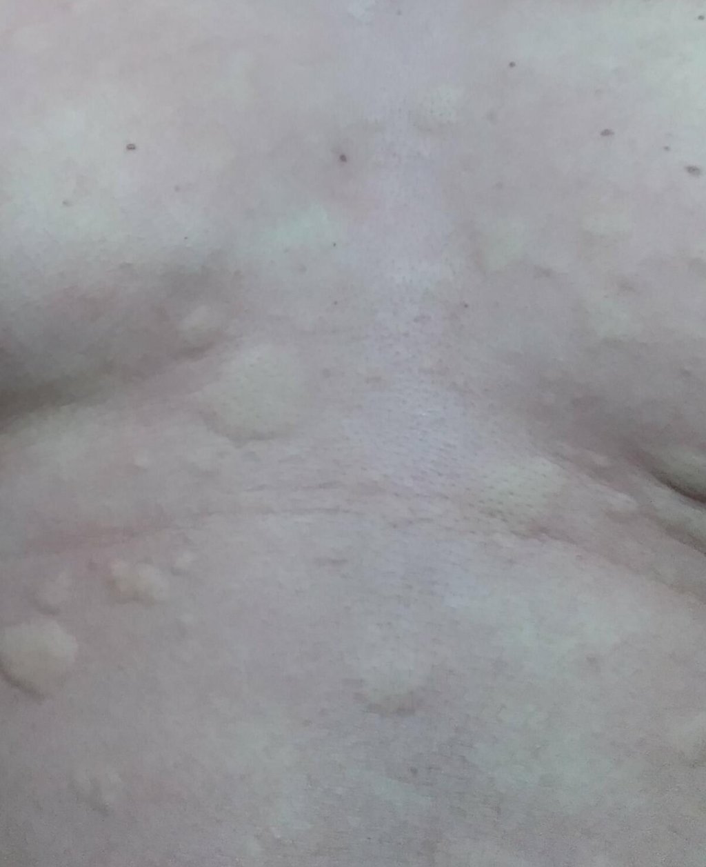Les réactions d’hypersensibilité au soleil sont-elles fréquentes ?