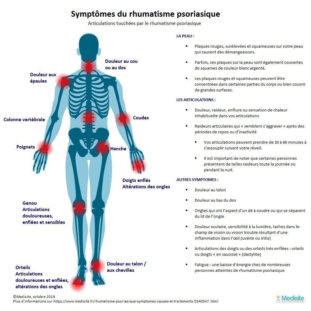 La fatigue dans le rhumatisme psoriasique