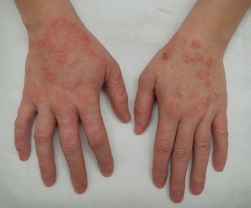 Définition : qu'est-ce l'eczéma des mains ?