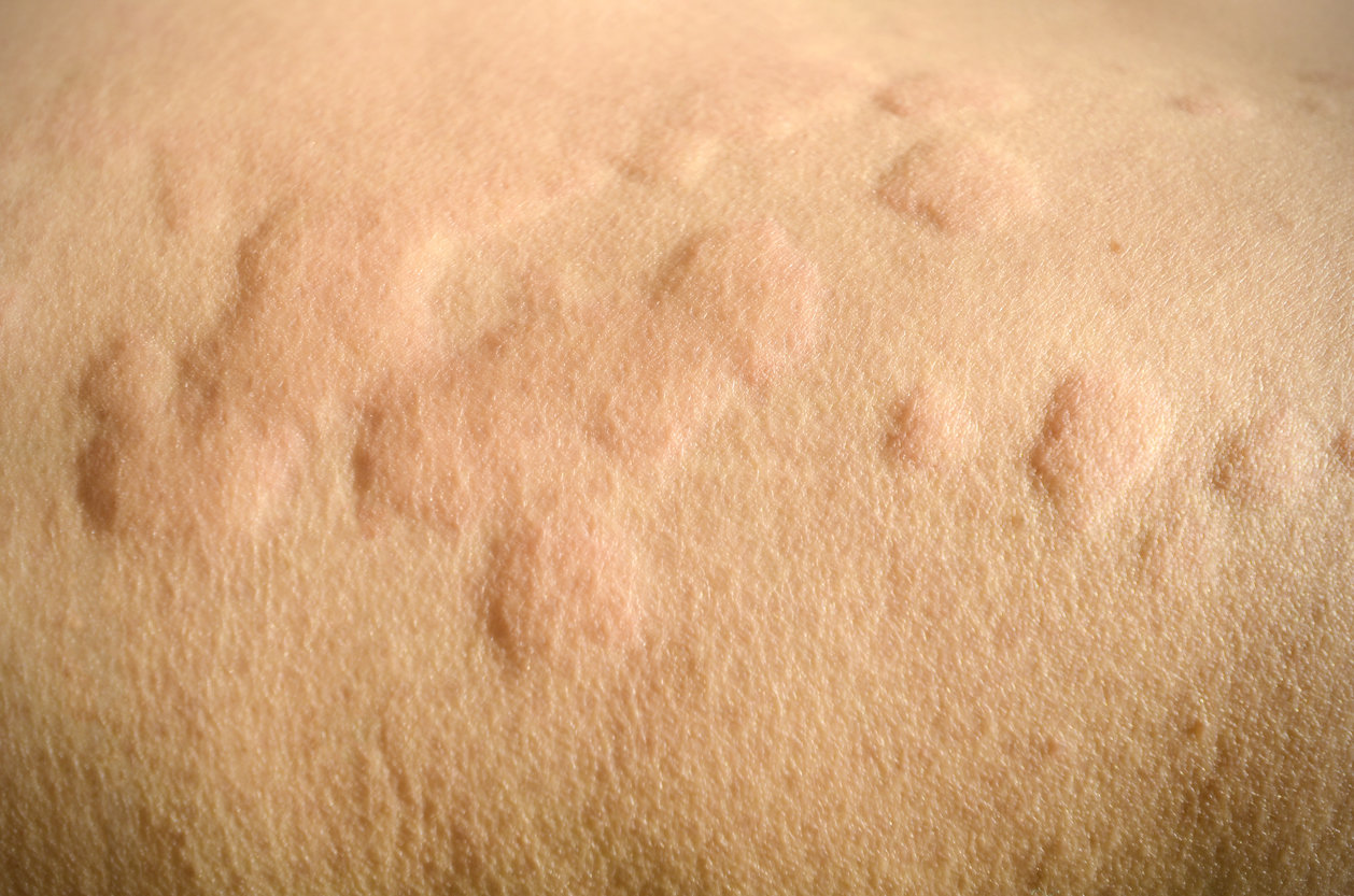 Nouvelle étude : les framboises noires prometteuses pour réduire l'inflammation de la peau