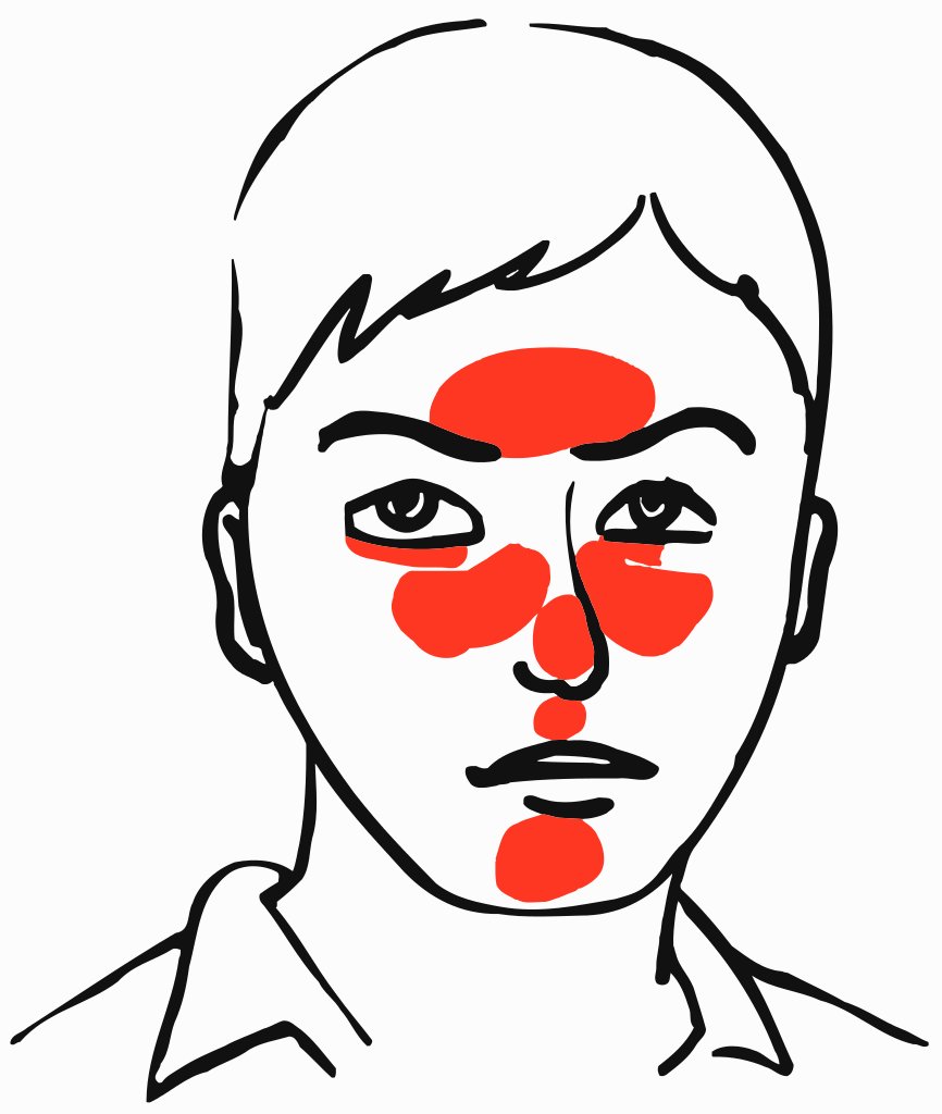 Quelles sont les personnes à risque de chalazion ?