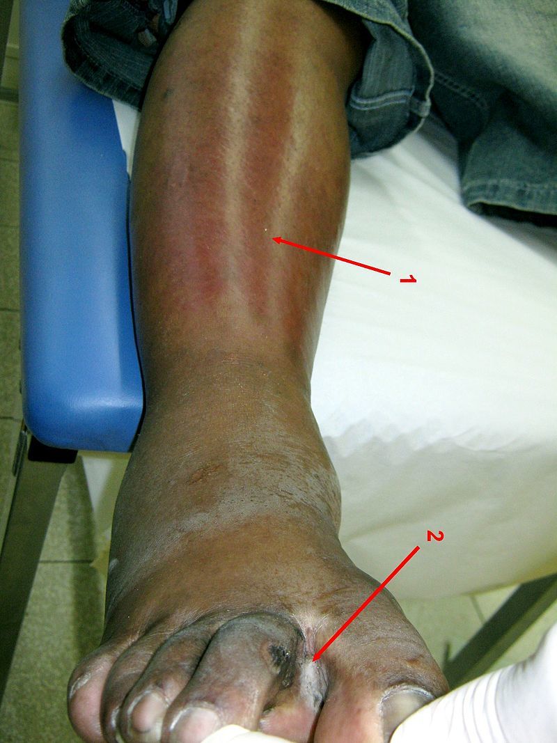 Érysipèle des jambes
