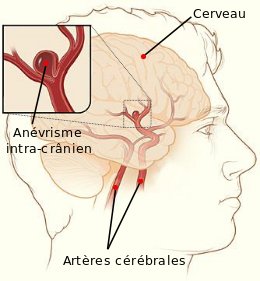 Comment se forment les anévrismes ?