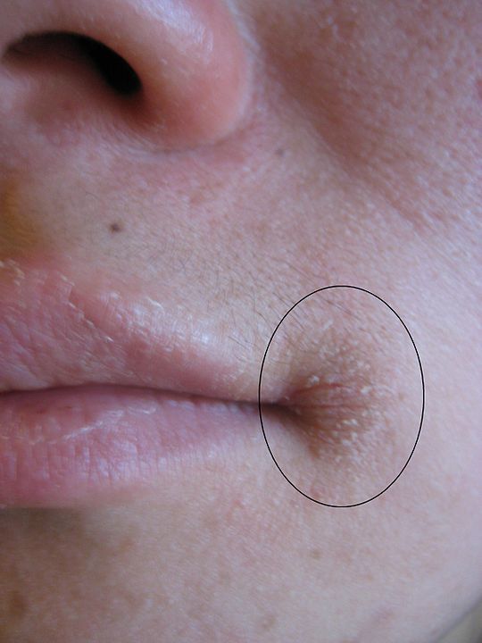 Symptômes : comment reconnaître une perlèche ?
