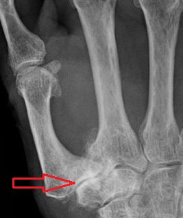 Quelles sont les causes de la rhizarthrose ?