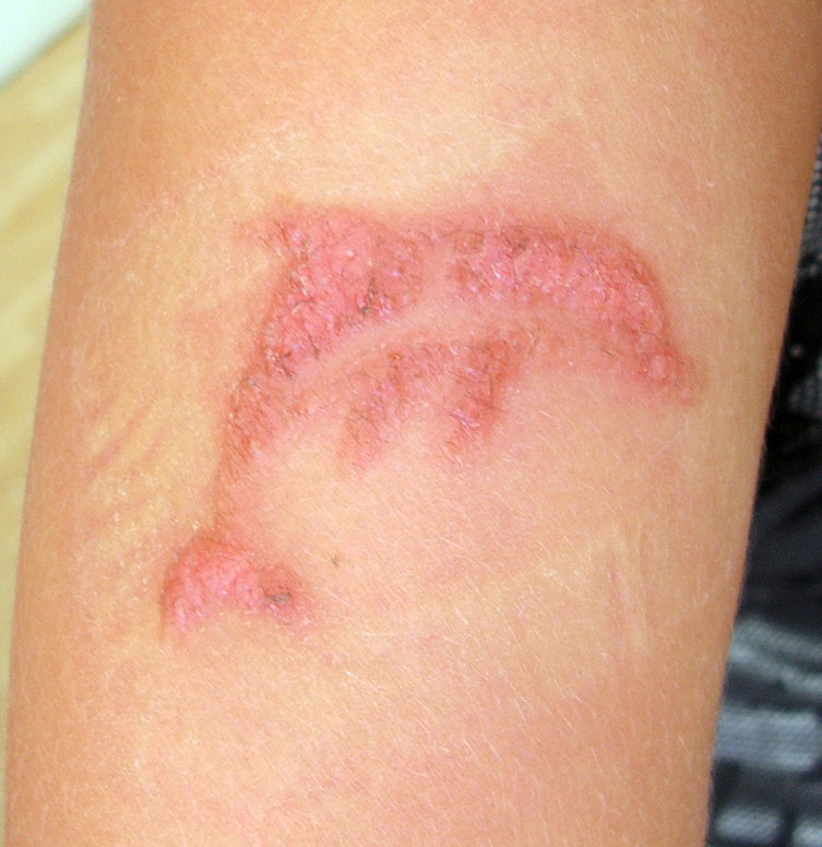 Quels sont les symptômes de cette dermatite allergique ?