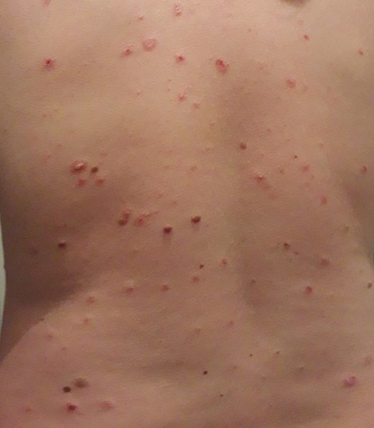 Le Psoriasis en gouttes