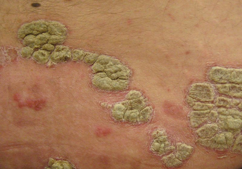 Le psoriasis pustuleux