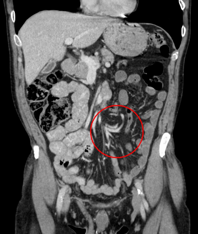 Les occlusions par obstruction 