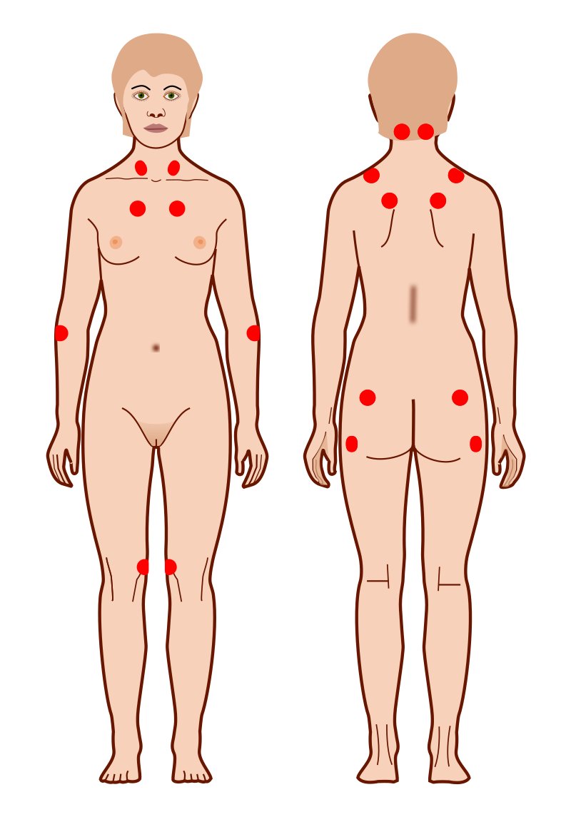 Localisation des points sensibles répondant aux critères du collège américains pour la fibromyalgie