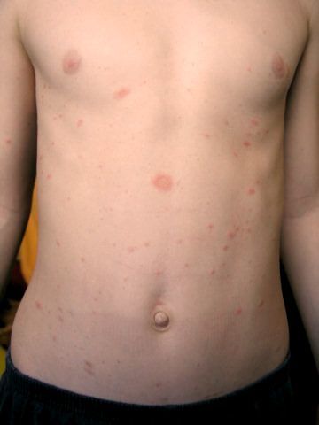 Quels sont ses symptômes du pityriasis rosé de Gibert ?