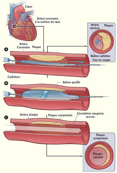 Quels sont les traitements de l'artériopathie oblitérante ?