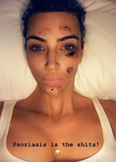 Psoriasis, acné, rondeurs : 10 stars qui ont révélé leurs complexes