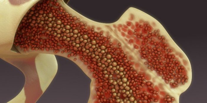 12 cancers oÃ¹ le taux de survie sâest amÃ©liorÃ©