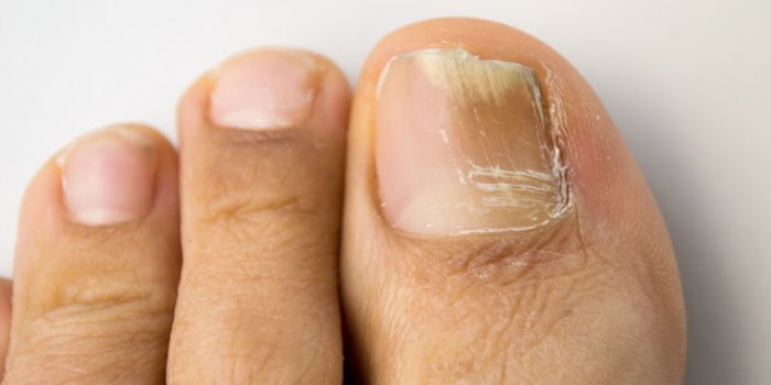 Maladies : 10 signes rÃ©vÃ©lateurs sur vos pieds 