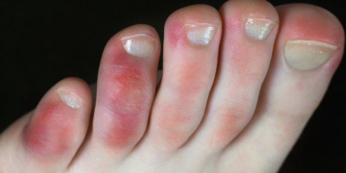 Maladies : 10 signes rÃ©vÃ©lateurs sur vos pieds 
