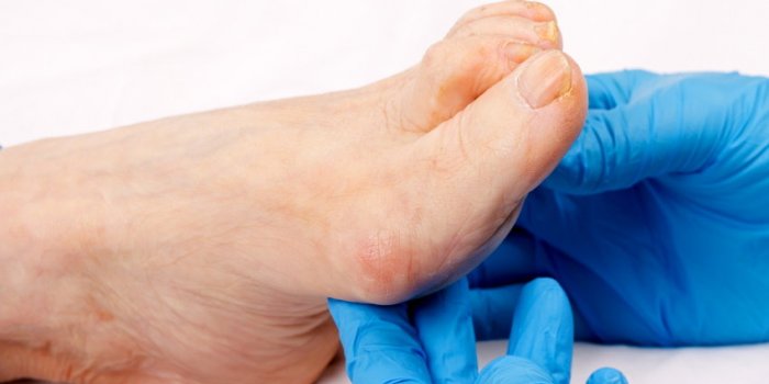 Maladies : 10 signes rÃ©vÃ©lateurs sur vos pieds 