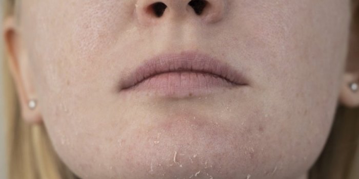 Votre peau est sèche et/ou irritée
