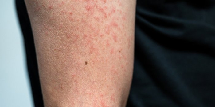 Vaccin Pfizer : les effets indésirables observés en France par l'ANSM