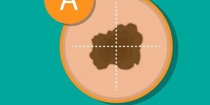 Cancer de la peau : une dermatologue liste les 5 signes prÃ©coces