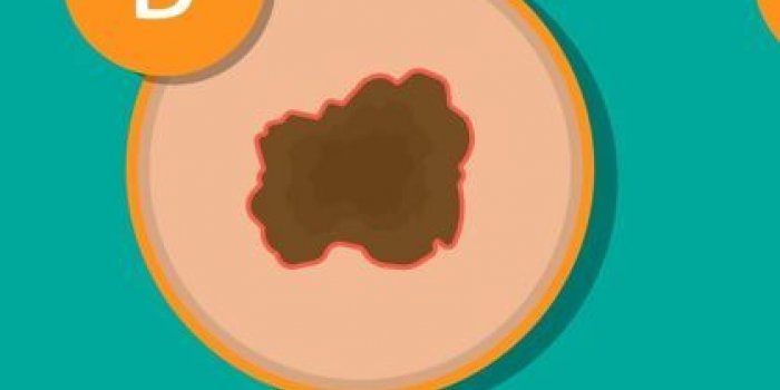 Cancer de la peau : une dermatologue liste les 5 signes prÃ©coces