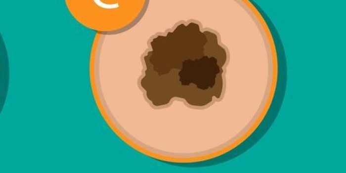 Cancer de la peau : une dermatologue liste les 5 signes prÃ©coces