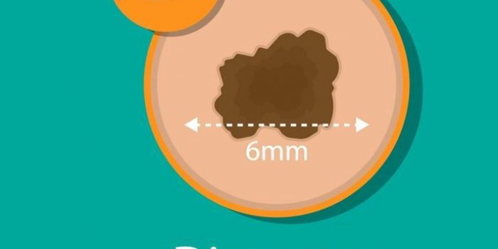 Cancer de la peau : une dermatologue liste les 5 signes prÃ©coces