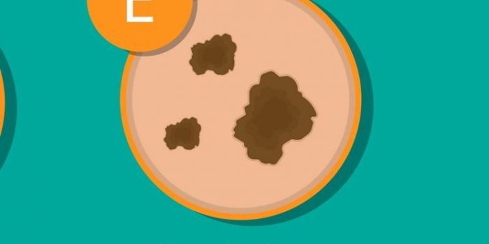 Cancer de la peau : une dermatologue liste les 5 signes prÃ©coces