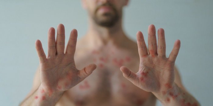 Méningite : quels sont les principaux symptômes ?