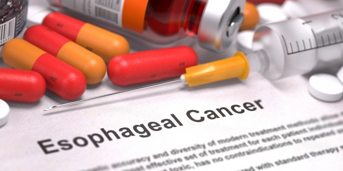 RGO : 5 complications du reflux gastro-Åsophagien à connaître