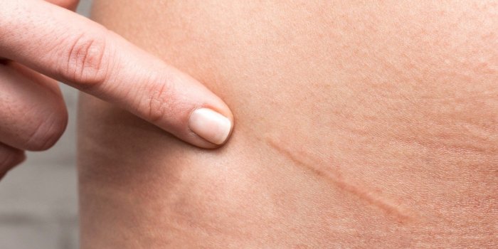 RGO : 5 complications du reflux gastro-Åsophagien à connaître