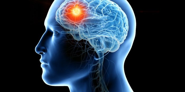 Les 9 formes de tumeurs cÃ©rÃ©brales