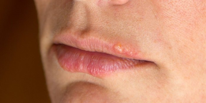 Hiver : 5 signes qui montrent que votre peau souffre du froid