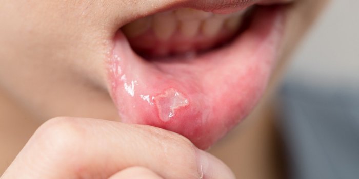 5 signes sur votre langue qui doivent vous alerter