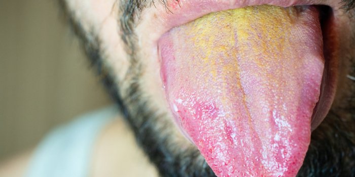 male mouth with a protruding tongue with a yellow coating at the base