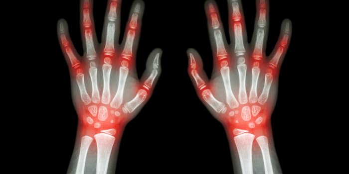rheumatoid arthritis , gout arthritis ( film x-ray both hands of child with multiple joint arthritis ) ( medical , scienc...