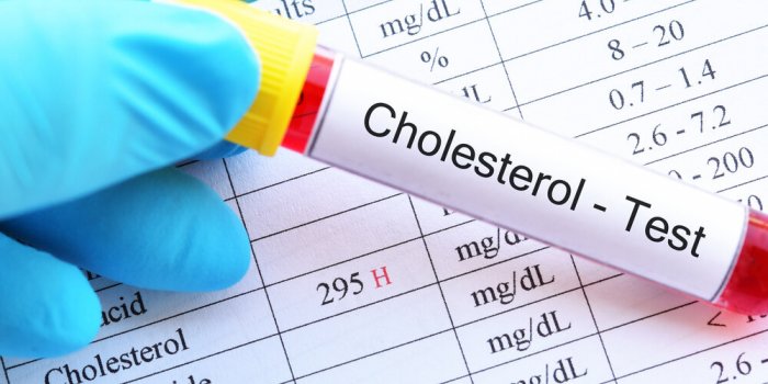 blood sample tube with abnormal high cholesterol test result