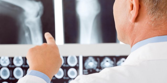 Myélome : 9 symptômes qui trahissent ce cancer de la moelle osseuse