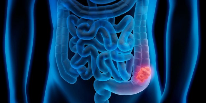 Régime cétogène : les 5 maladies graves qu'il peut entraîner