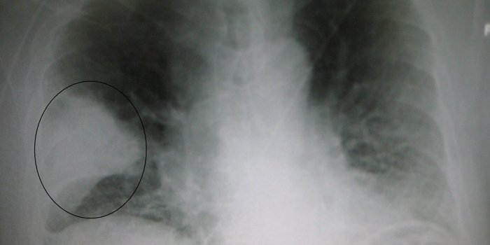 L'OMS identifie 17 vaccins Ã  dÃ©velopper en urgence