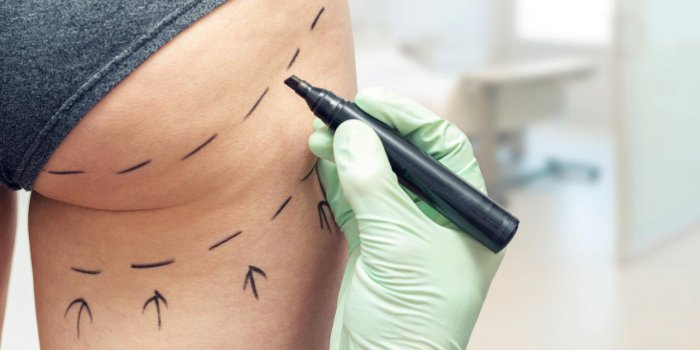 Le lipofilling des fesses