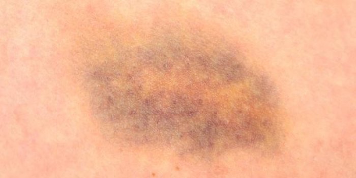 Myélome : 9 symptômes qui trahissent ce cancer de la moelle osseuse