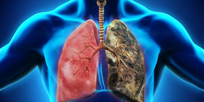 Les 5 cancers les plus fréquents dans le monde en 2020